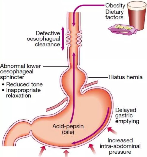 Reflusso gastrico