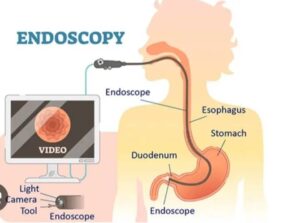 Edg Scan Gastroscopy or EGD: Everything you need to know!
